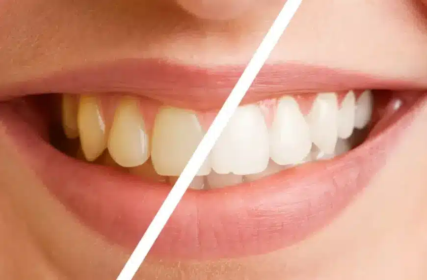 Come pulire i denti gialli: 5 consigli e metodi per un sorriso più luminoso